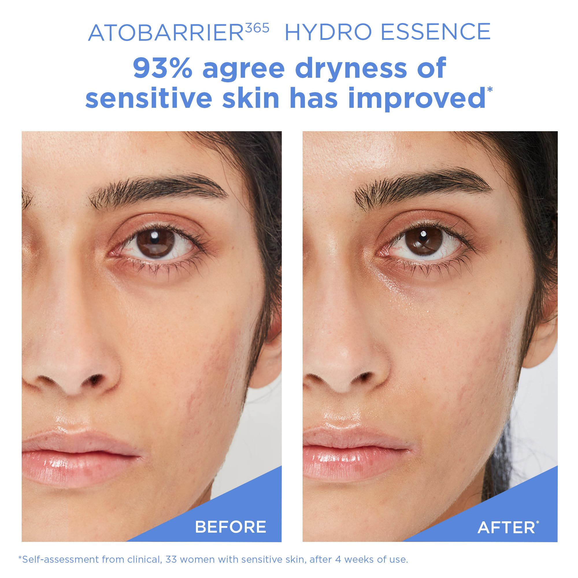 AESTURA ATOBARRIER365 Hydro Essence with Hydrating Amino Acids | Lightweight Formula, Deep Hydration, Suitable for Dry & Sensitive Skin, Non-Comedogenic, 200ML / 6.76 fl. oz.